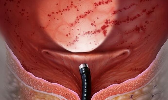 Cistitis